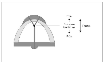 Figura 1 - Desenho esquemático representando uma vista oclusal da maxila, colocando o forame incisivo como ponto focal e estratégico do sistema de classificação de fissuras labiopalatinas proposto por Spina et al. (1972).